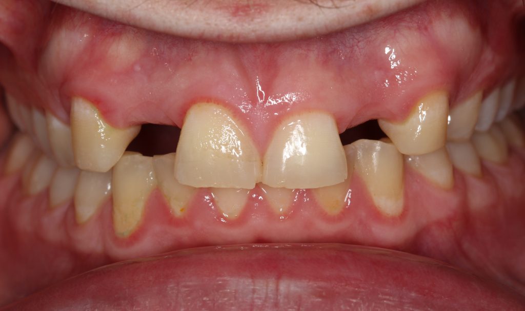 Implant Planning Using Ez3D-i and Ez3D Plus - #7 and #10 - GreenCT